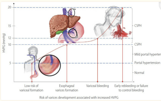 Varices - Esophageal and Gastric in Liver Cirrhosis