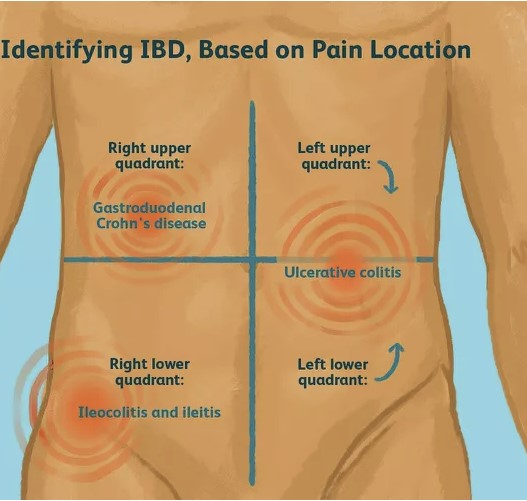 Irritable Bowel Syndrome (IBS) and Non-Alcoholic Fatty Liver Disease (NAFLD) - Piecing Together the Puzzle