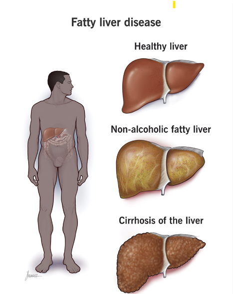 Nonalcoholic Fatty Liver Disease - Exploring the Surge